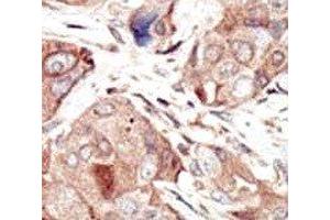 IHC analysis of FFPE human breast carcinoma tissue stained with the VEGFR2 antibody (VEGFR2/CD309 抗体  (AA 1326-1356))