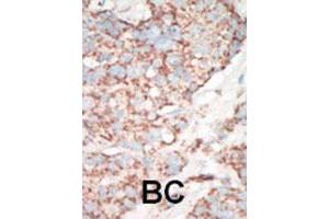 Formalin-fixed and paraffin-embedded human cancer tissue reacted with STK25 polyclonal antibody  , which was peroxidase-conjugated to the secondary antibody, followed by AEC staining. (STK25 抗体  (C-Term))