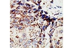 IHC analysis of FFPE human breast carcinoma tissue stained with the BAP1 antibody (BAP1 抗体  (AA 36-66))