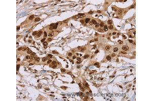 Immunohistochemistry of Human colon cancer using NUP50 Polyclonal Antibody at dilution of 1:30 (NUP50 抗体)