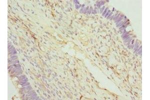 Immunohistochemistry of paraffin-embedded human ovarian cancer using ABIN7166597 at dilution of 1:100 (FAM20A 抗体  (AA 140-240))