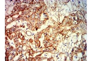 Immunohistochemical analysis of paraffin-embedded rectal cancer tissues using CTNNB1 mouse mAb with DAB staining. (CTNNB1 抗体  (AA 632-781))