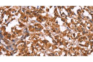 Immunohistochemistry of paraffin-embedded Human thyroid cancer using GUK1 Polyclonal Antibody at dilution of 1:50 (GUK1 抗体)