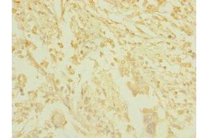 Immunohistochemistry of paraffin-embedded human pancreatic cancer using ABIN7171534 at dilution of 1:100 (TAS1R3 抗体  (AA 400-570))