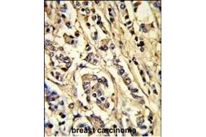Formalin-fixed and paraffin-embedded human breast carcinoma reacted with VGFR2 Antibody, which was peroxidase-conjugated to the secondary antibody, followed by DAB staining. (VEGFR2/CD309 抗体)