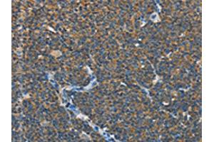 The image on the left is immunohistochemistry of paraffin-embedded Human lymphoma tissue using ABIN7131012(SEPT9 Antibody) at dilution 1/15, on the right is treated with fusion protein. (Septin 9 抗体)