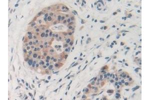Detection of MMP19 in Human Pancreatic cancer Tissue using Polyclonal Antibody to Matrix Metalloproteinase 19 (MMP19) (MMP19 抗体  (AA 98-508))