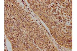 IHC image of ABIN7140203 diluted at 1:100 and staining in paraffin-embedded human cervical cancer performed on a Leica BondTM system. (Tumor Protein p73 抗体  (AA 537-555))