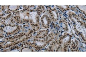 Immunohistochemistry of paraffin-embedded Human thyroid cancer tissue using DAN Polyclonal Antibody at dilution 1:50 (PARN 抗体)