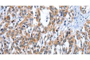 Immunohistochemistry of paraffin-embedded Human esophagus cancer tissue using EDN3 Polyclonal Antibody at dilution 1:30 (Endothelin 3 抗体)