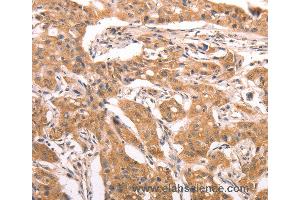 Immunohistochemistry of Human lung cancer using AASDHPPT Polyclonal Antibody at dilution of 1:30 (AASDHPPT 抗体)