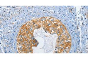 Immunohistochemistry of paraffin-embedded Human cervical cancer tissue using DGK zeta Polyclonal Antibody at dilution 1:60 (DGKZ 抗体)
