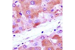 Immunohistochemical analysis of Annexin A4 staining in human liver cancer formalin fixed paraffin embedded tissue section. (Annexin IV 抗体)