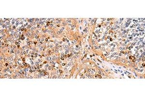 Immunohistochemistry of paraffin-embedded Human liver cancer tissue using KANSL1L Polyclonal Antibody at dilution of 1:40(x200) (KANSL1L 抗体)