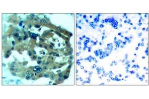 Immunohistochemical analysis of paraffin-embedded human lung carcinoma tissue, using Merlin (Ab-518) antibody (E021258). (Merlin 抗体)