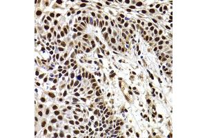 Immunohistochemistry of paraffin-embedded human well-differentiated squamous skin carcinoma using HIRIP3 antibody (ABIN5974221) at dilution of 1/100 (40x lens). (HIRIP3 抗体)