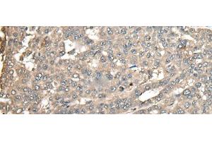 Immunohistochemistry of paraffin-embedded Human liver cancer tissue using ATXN3 Polyclonal Antibody at dilution of 1:100(x200) (Ataxin 3 抗体)