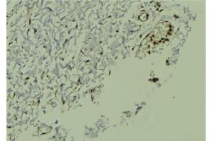 ABIN6272970 at 1/100 staining Human breast cancer tissue by IHC-P. (NR1H2 抗体  (Internal Region))