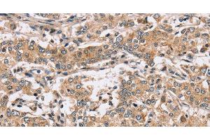 Immunohistochemistry of paraffin-embedded Human liver cancer using PPP1CC Polyclonal Antibody at dilution of 1:40 (PPP1CC 抗体)