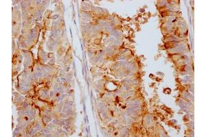 IHC image of ABIN7127379 diluted at 1:100 and staining in paraffin-embedded human endometrial cancer performed on a Leica BondTM system. (Recombinant MUC16 抗体)