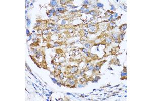 Immunohistochemistry of paraffin-embedded human breast cancer using NDE1 antibody (ABIN5974277) at dilution of 1/100 (40x lens). (NDE1 抗体)