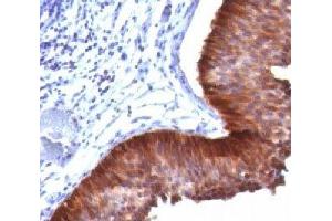 IHC testing of bladder carcinoma stained with Cytokeratin 17 antibody. (KRT17 抗体)