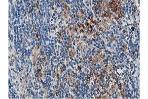 Immunohistochemical staining of paraffin-embedded Human lymphoma tissue using anti-PTPN1 mouse monoclonal antibody. (PTPN1 抗体)