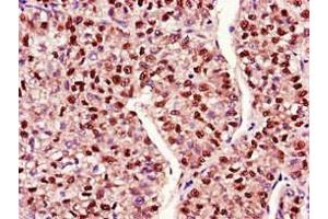 Immunohistochemistry of paraffin-embedded human liver cancer using ABIN7150711 at dilution of 1:100 (MAP2K4 抗体  (AA 259-398))