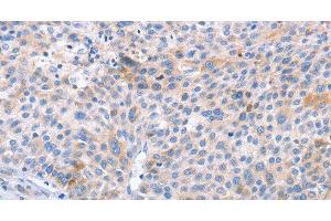 Immunohistochemistry of paraffin-embedded Human liver cancer using STK4 Polyclonal Antibody at dilution of 1:70 (STK4 抗体)