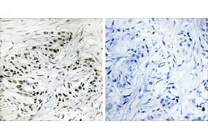 Peptide - +Immunohistochemistry analysis of paraffin-embedded human breast carcinoma tissue, using ERF antibody. (ERF 抗体  (Internal Region))