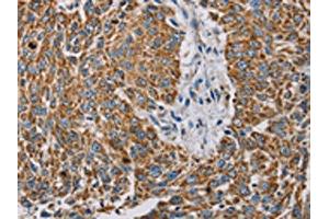 The image on the left is immunohistochemistry of paraffin-embedded Human lung cancer tissue using ABIN7130290(MTFP1 Antibody) at dilution 1/30, on the right is treated with fusion protein. (Mtfp1 抗体)