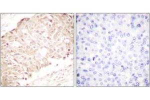 Immunohistochemistry analysis of paraffin-embedded human breast carcinoma tissue, using SENP1 Antibody. (SENP1 抗体  (AA 1-50))