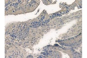 ABIN6255502 and ABIN6267099 at 1/100 staining human colon carcinoma by IHC-P. (BIM 抗体  (pSer77))