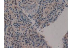 Detection of CIRBP in Human Skin cancer Tissue using Polyclonal Antibody to Cold Inducible RNA Binding Protein (CIRBP)