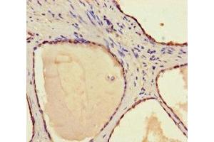 Immunohistochemistry of paraffin-embedded human prostate cancer using ABIN7170686 at dilution of 1:100 (STAMBP 抗体  (AA 1-424))