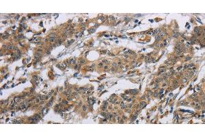Immunohistochemistry of paraffin-embedded Human gastic cancer using SYN2 Polyclonal Antibody at dilution of 1:40 (SYN2 抗体)