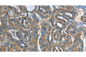 Immunohistochemistry of paraffin-embedded Human thyroid cancer tissue using ADCY4 Polyclonal Antibody at dilution 1:45 (ADCY4 抗体)