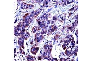 Caspase-6 antibody immunohistochemistry analysis in formalin fixed and paraffin embedded human bladder carcinoma. (Caspase 6 抗体  (AA 17-45))
