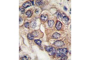 Formalin-fixed and paraffin-embedded human hepatocarcinoma tissue reacted with PDGFRA Antibody  (ABIN392024 and ABIN2841799) , which was peroxidase-conjugated to the secondary antibody, followed by DAB staining. (PDGFRA 抗体  (AA 698-727))