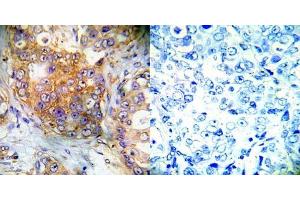 Immunohistochemical analysis of paraffin- embedded human breast carcinoma tissue using 4E-BP1 (Ab-65) antibody (E022001). (eIF4EBP1 抗体)