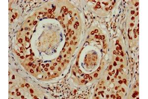 IHC image of ABIN7150328 diluted at 1:600 and staining in paraffin-embedded human cervical cancer performed on a Leica BondTM system. (MCM2 抗体  (AA 2-904))