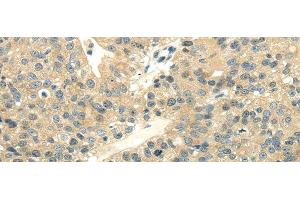Immunohistochemistry of paraffin-embedded Human breast cancer using UBL4A Polyclonal Antibody at dilution of 1/40