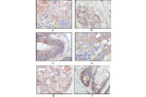 Immunohistochemical analysis of paraffin-embedded human lung squamous cell carcinoma (A), lung adenocarcinoma (B), colon carcinoma (C), breast carcinoma (D), normal sublingual gland (E), normal rectal (F), showing membrane localization with DAB staining using EphB3 antibody. (EPH Receptor B3 抗体  (AA 39-212))