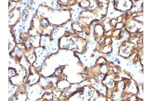 Formalin-fixed, paraffin-embedded human Angiosarcoma stained with CD34 Monoclonal Antibody (HPCA1/1171) (CD34 抗体)