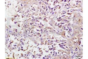 Formalin-fixed and paraffin embedded human lung carcinoma labeled with Anti-SPARC Polyclonal Antibody, Unconjugated (ABIN738141) at 1:200 followed by conjugation to the secondary antibody and DAB staining. (SPARC 抗体  (AA 101-200))