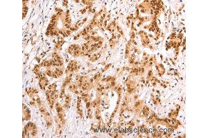 Immunohistochemistry of Human esophagus cancer using TAX1BP1 Polyclonal Antibody at dilution of 1:60 (TAX1BP1 抗体)