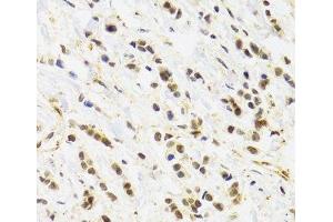 Immunohistochemistry of paraffin-embedded Human breast cancer using RAD50 Polyclonal Antibody at dilution of 1:100 (40x lens). (RAD50 抗体)