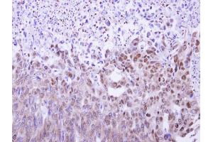 IHC-P Image MAF1 antibody detects MAF1 protein at nucleus and cytoplasm on human colon carcinoma by immunohistochemical analysis.