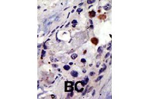 Formalin-fixed and paraffin-embedded human cancer tissue reacted with PSMD4 polyclonal antibody  , which was peroxidase-conjugated to the secondary antibody, followed by AEC staining. (PSMD4/ASF 抗体  (AA 300-328))
