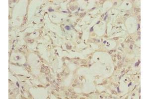 Immunohistochemistry of paraffin-embedded human pancreatic cancer using ABIN7158058 at dilution of 1:100 (LRTM1 抗体  (AA 1-212))